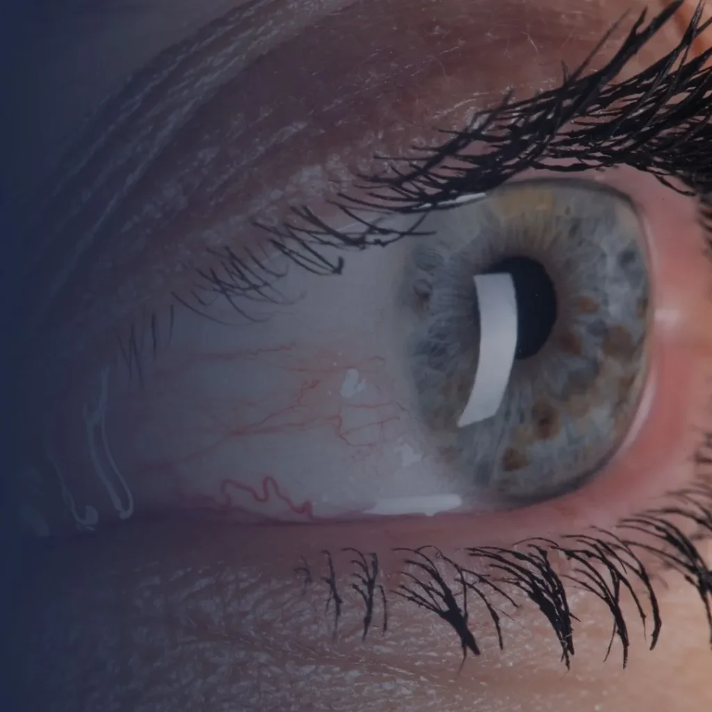 dry eyes treatment in Dubai and Abu Dhabi